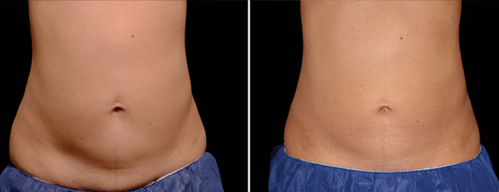 CoolSculpting Walnut Creek CA Before And After Photo